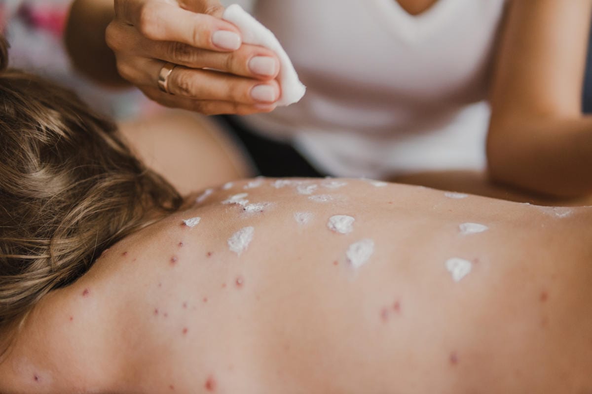 Kako se znebiti mozoljev na hrbtu, ramenih in prsih: učinkovite metode in nasveti