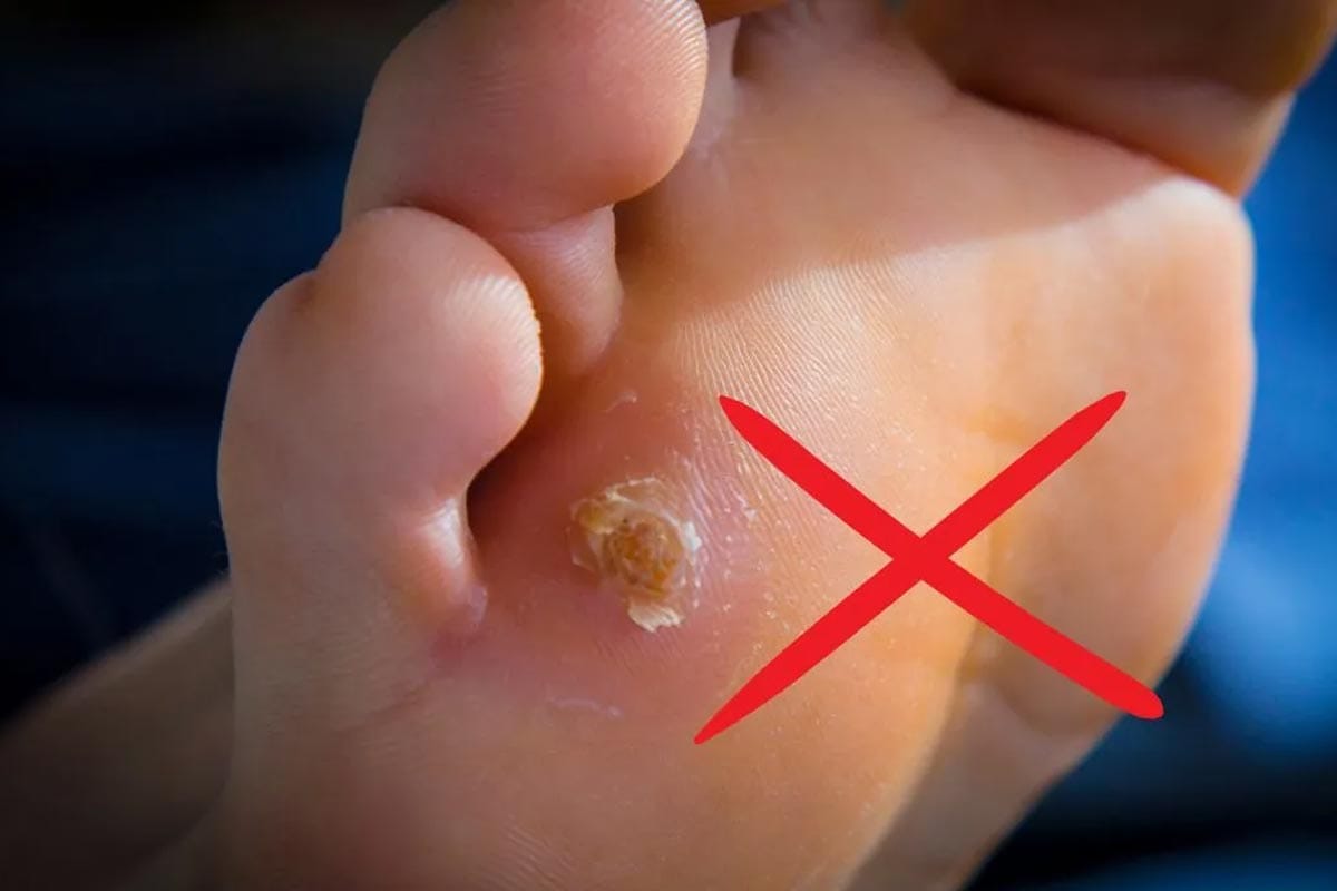 Kako odstraniti kurja očesa z učinkovitim domačim trikom: hitro in brez velikih stroškov