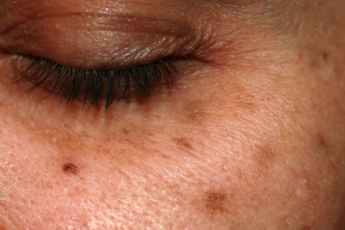 Ne le estetika: Kako se znebiti pigmentnih madežev na koži in preprečiti njihovo nastajanje