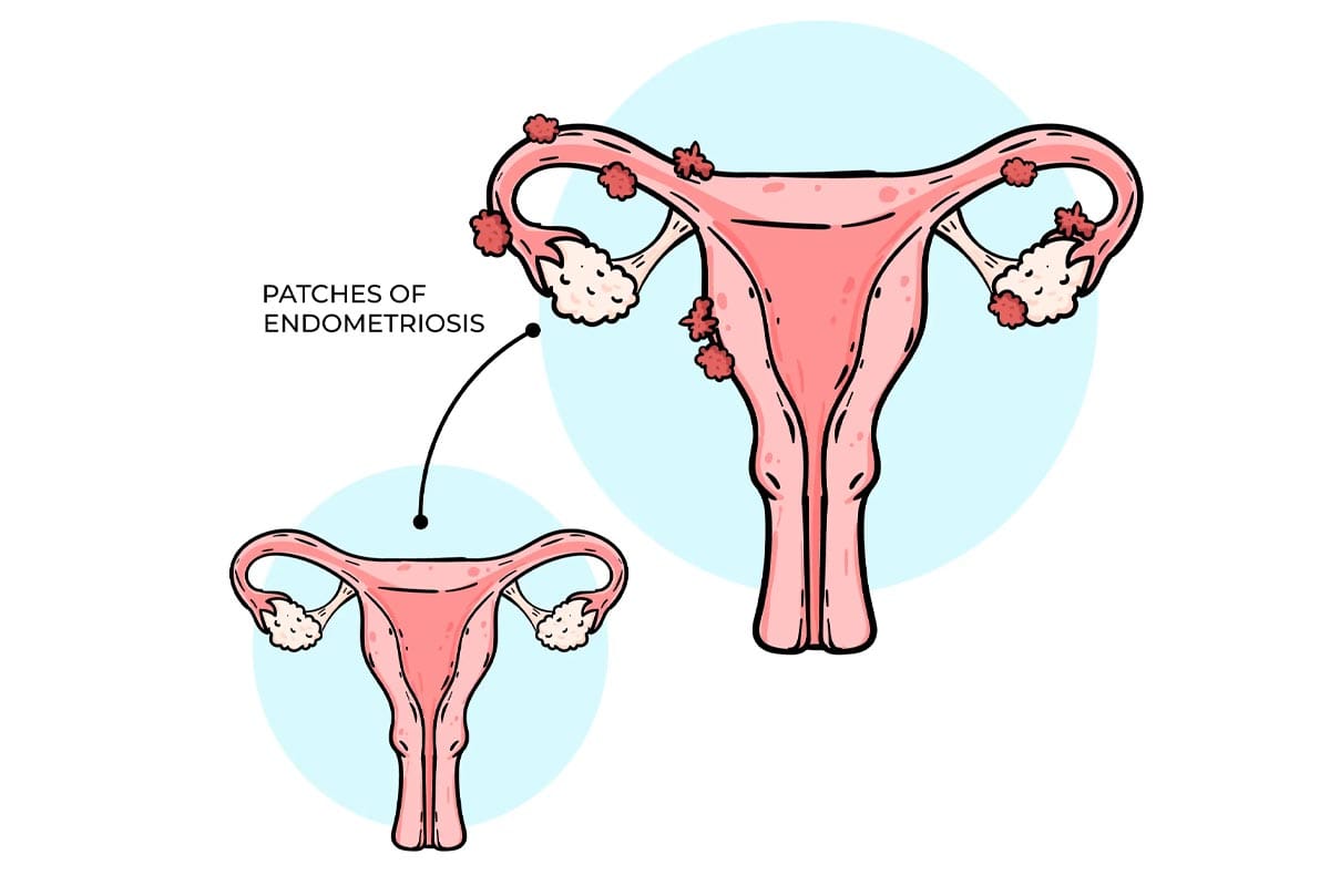 Če imate endometriozo, bodite pozorni na ta živila v svoji prehrani