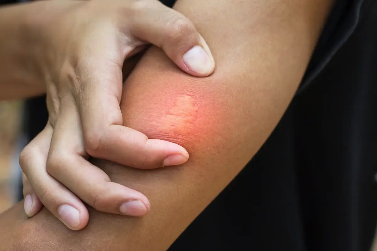 Ujed ose: pravila prve pomoči in 8 nasvetov, kako se mu izogniti