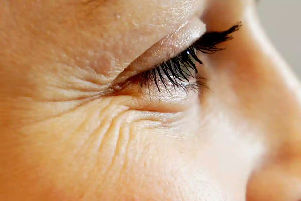 Ne le starost: Zakaj nastanejo gube in kako jih učinkovito zmanjšati