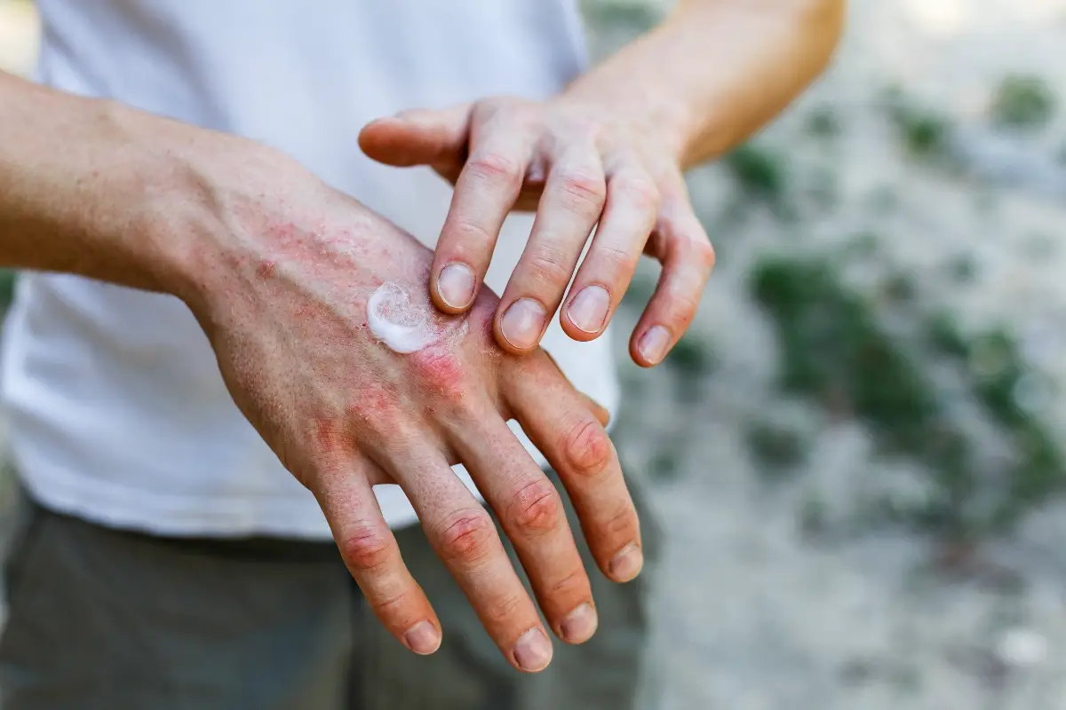 Ne dotikaj se tega! Kaj je kontaktni dermatitis