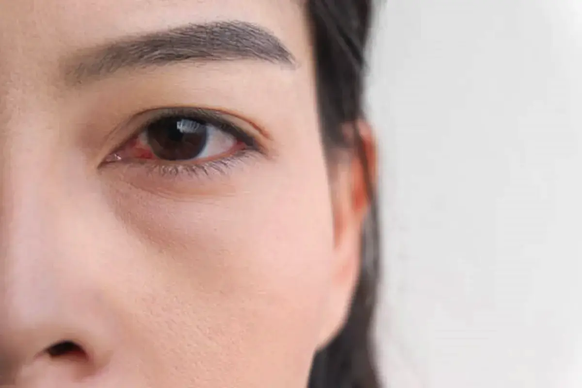 Počen očesni žilici: takoj k zdravniku ali počakati, da mine samo od sebe?