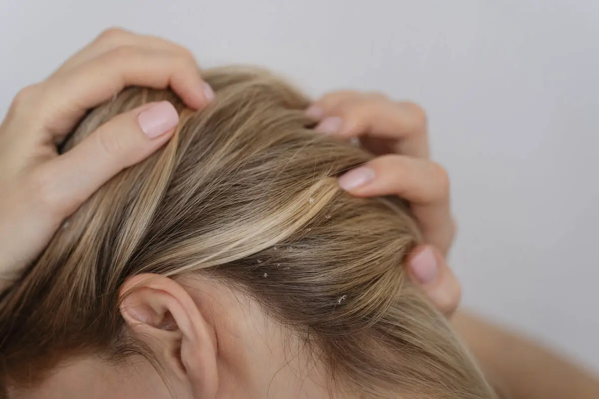 Zakaj se pojavi prhljaj in kako se ga znebiti