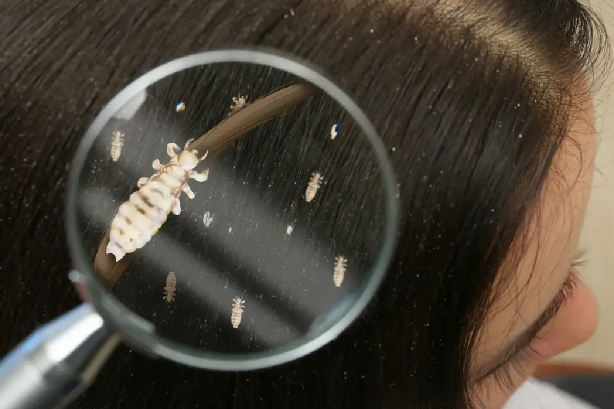 Jabolčni kis proti ušem in gnidam: naravni triki, ki res delujejo