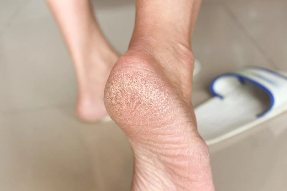 Črne in razpokane pete izginejo v 7 dneh – 5 kuhinjskih trikov, ki jih dermatologi priporočajo za popolno obnovo