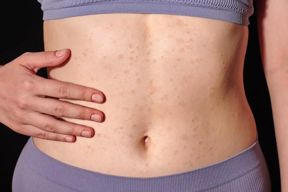 Čustvena alergija: Ko telo s fizičnimi simptomi reagira na čustvene situacije