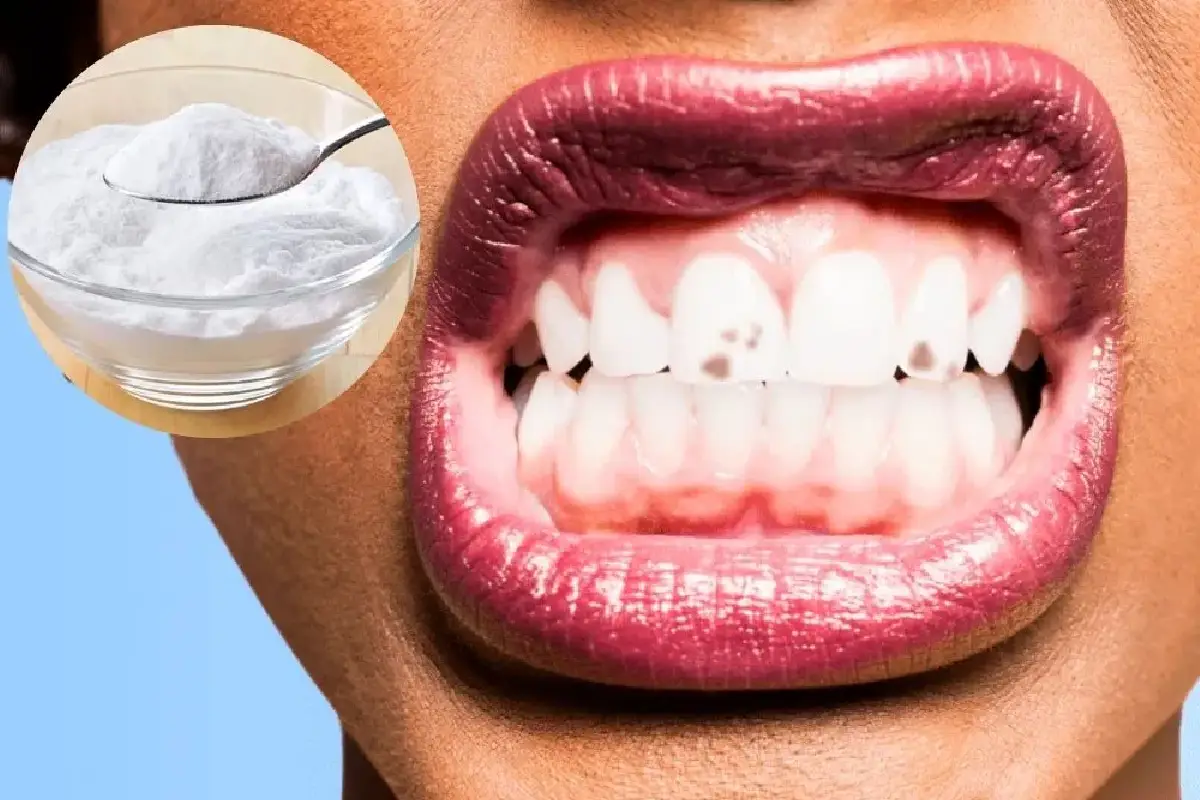 Kako s sodo bikarbono preprečiti zobni kamen, odstraniti madeže in narediti zobe naravno bolj bele